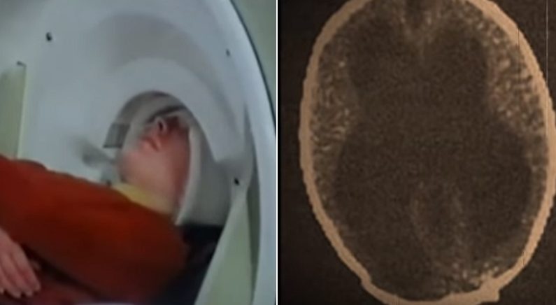 “머리가 너무 크다”며 병원 찾은 남성에게는 뇌가 없었다