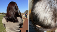 “손만 대도 머리카락이 우수수” 모더나 접종 뒤 ‘탈모 증상’ 호소한 20대 여성
